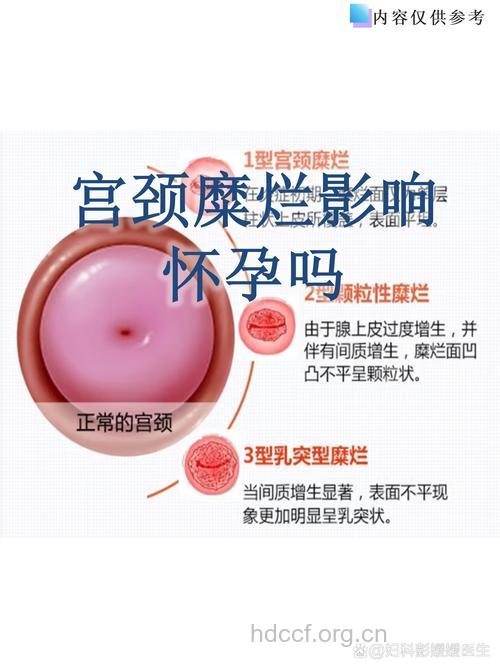 宫颈糜烂可以怀孕吗