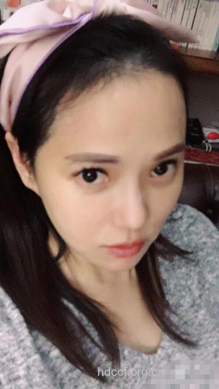 伊能静晒发际线标明“秃顶” 产后脱发怎回事