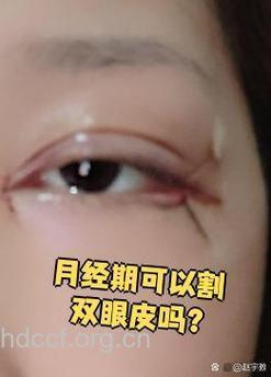 来例假能割双眼皮吗？