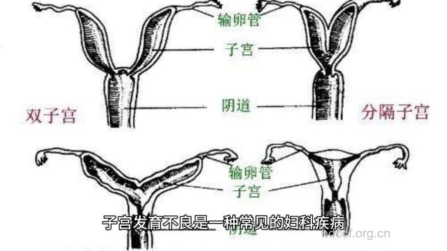 输卵管发育异常