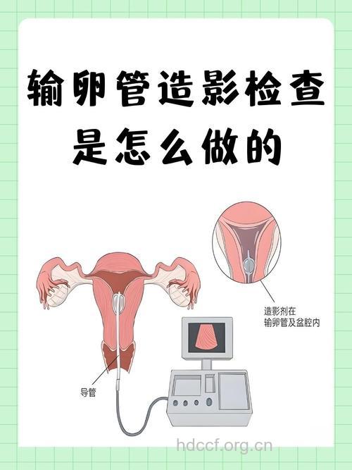 输卵管检查