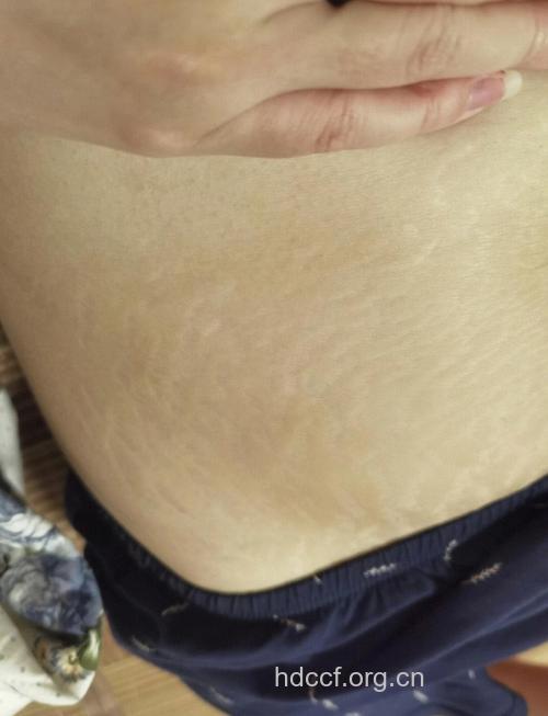 产后妊娠纹真的可以消除吗