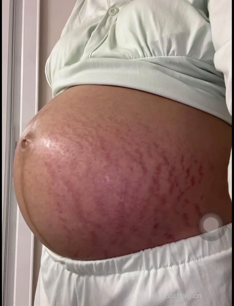 生二胎会出现妊娠纹吗