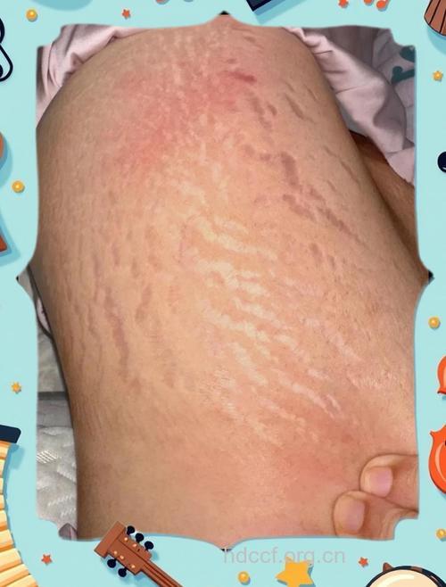 消除妊娠纹的错误观 你有吗