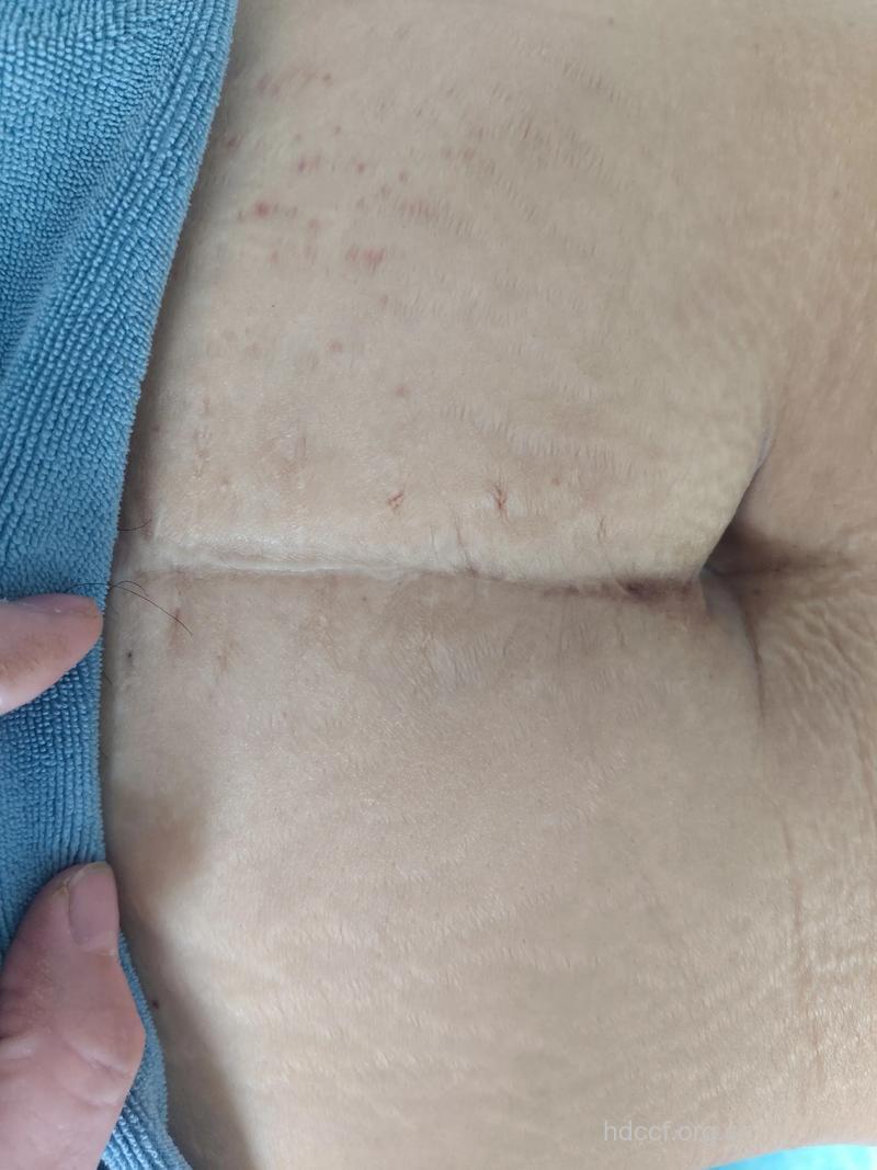 产后消除妊娠纹 辣妈们都这么做