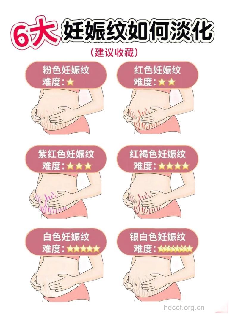 消除妊娠纹 妊娠期和产后方法各不同