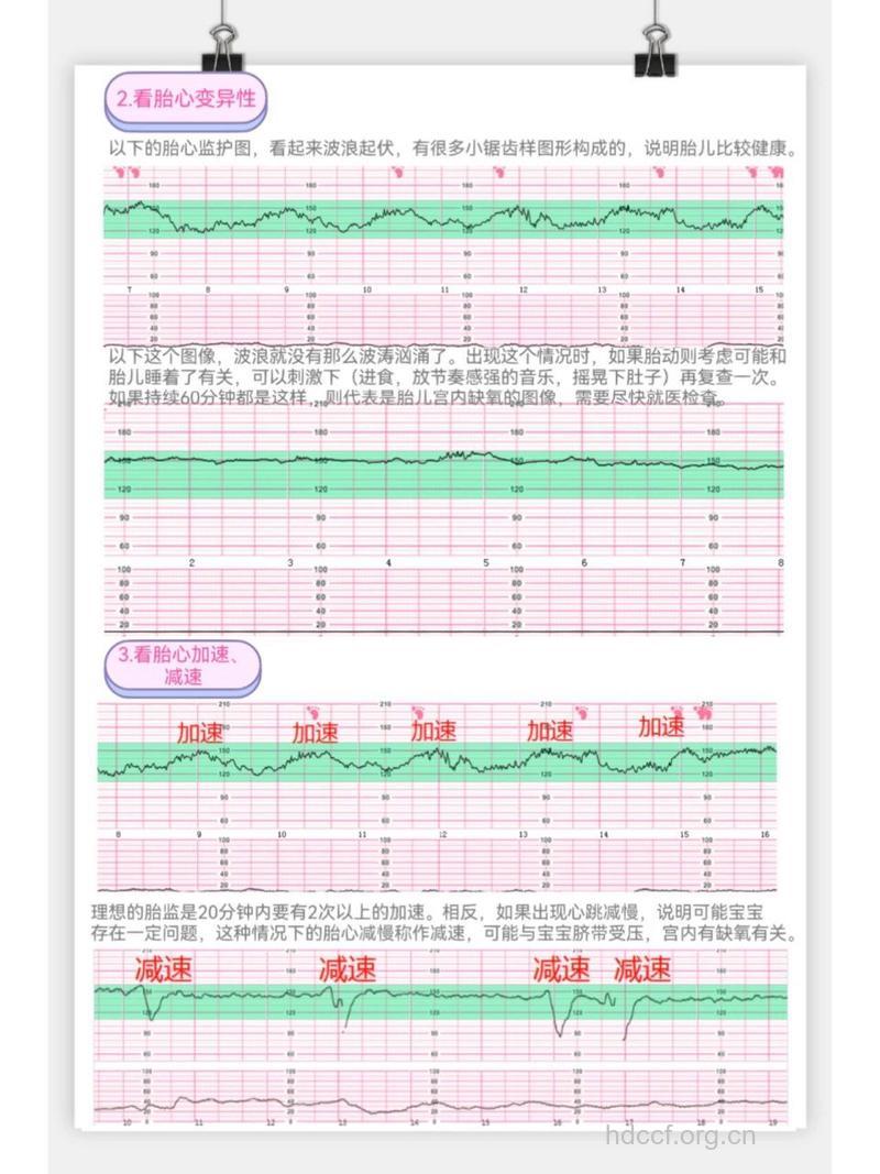 胎心监护正常值