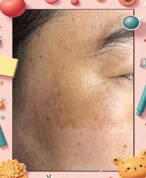 脸上长色斑或是月经不调