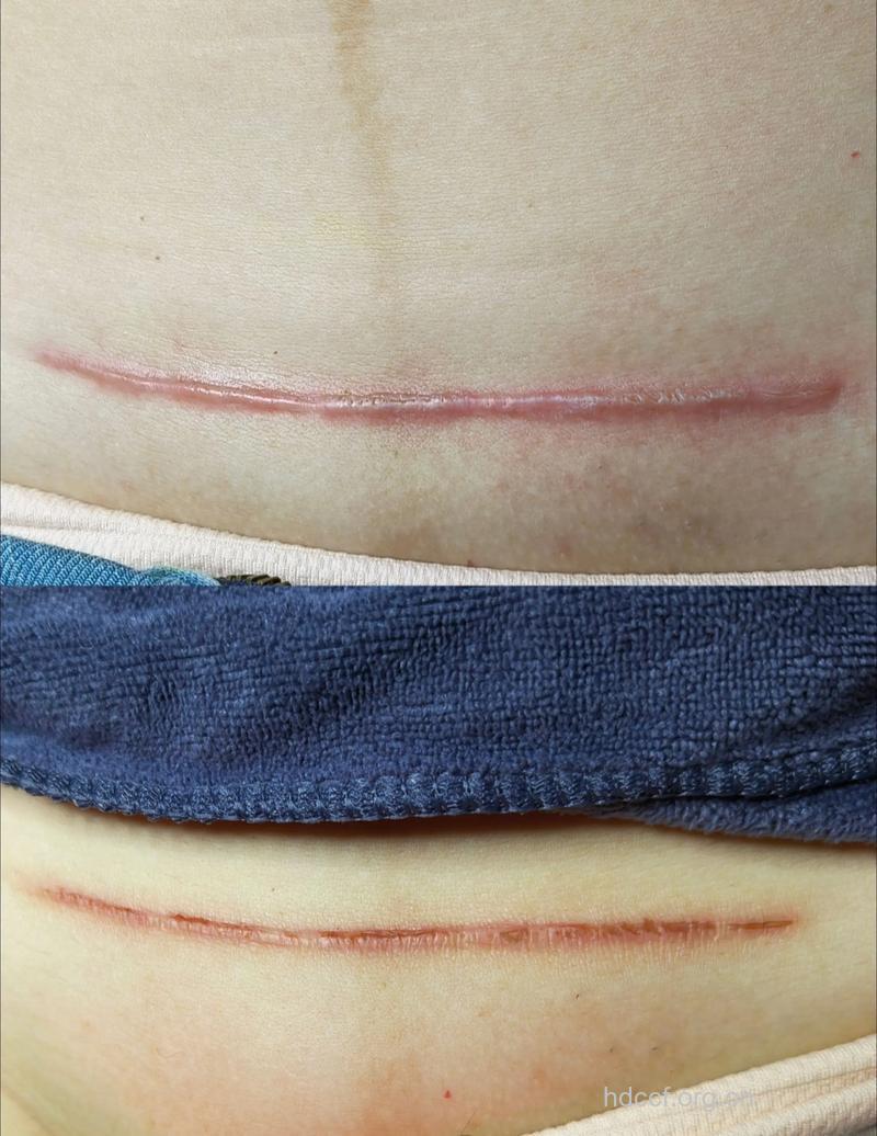 剖腹产疤痕如何修复