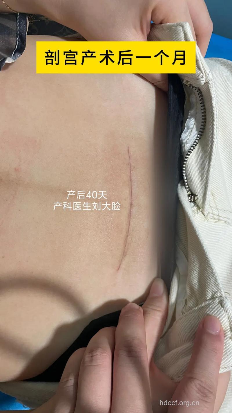 剖腹产后疤痕图片