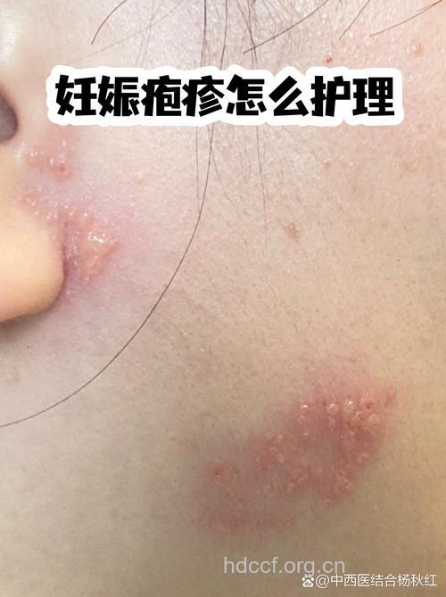妊娠疱疹