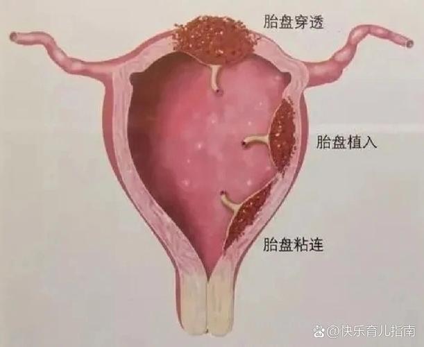 胎盘植入
