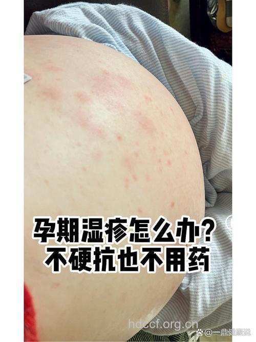孕妇湿疹