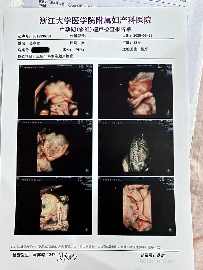 孕23周产检