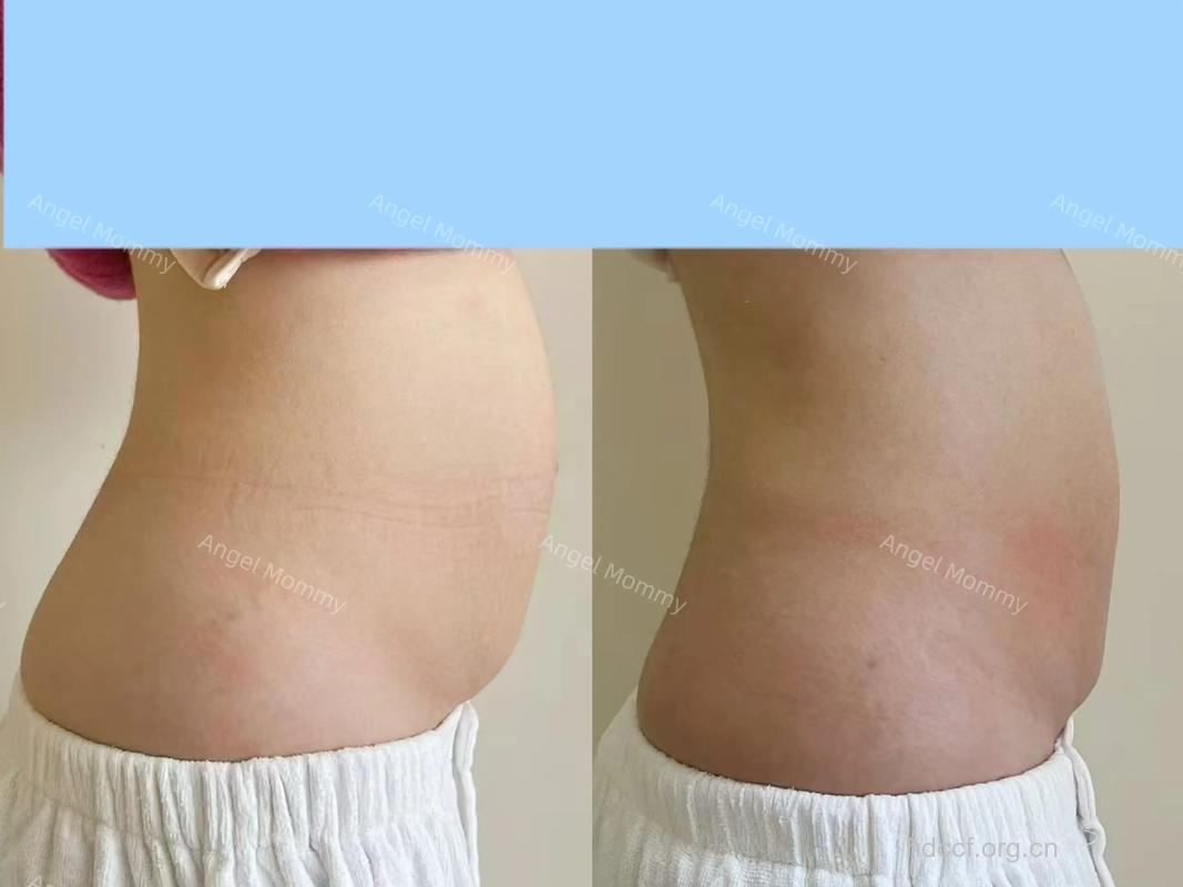 顺产比剖腹产难恢复身材吗