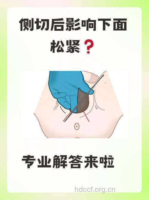 会阴侧切后 产后便秘会影响侧切吗