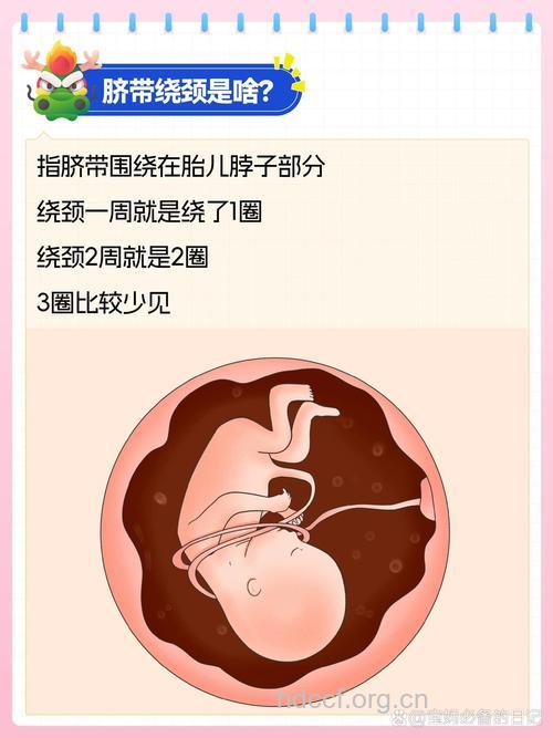 胎儿脐带绕颈