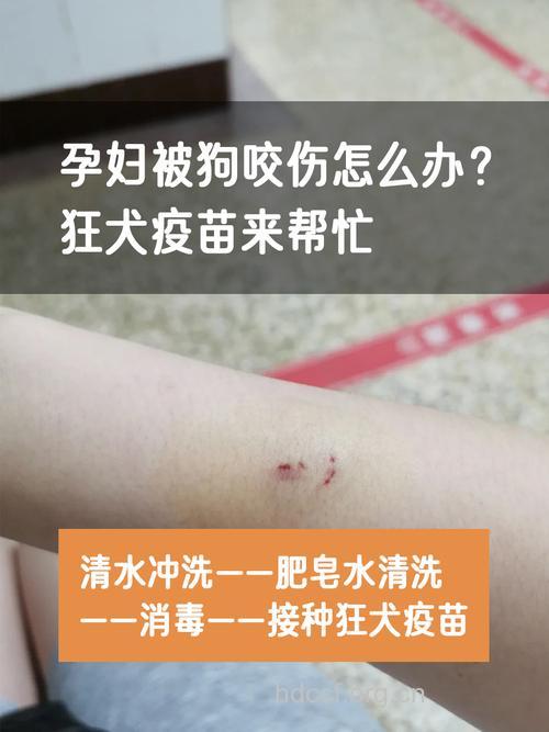 孕妇被狗咬了怎么办