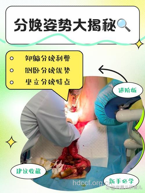 坐式分娩