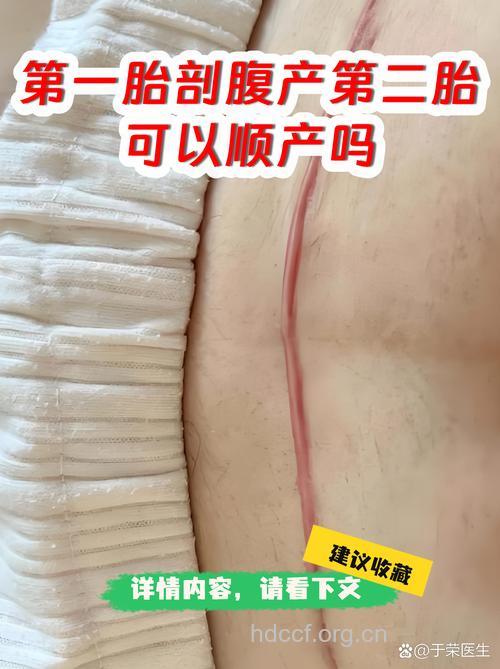 第一胎剖腹产第二胎能顺产吗