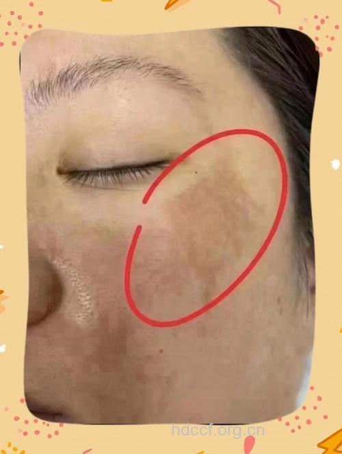 产后黄褐斑能治好吗