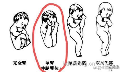臀先露