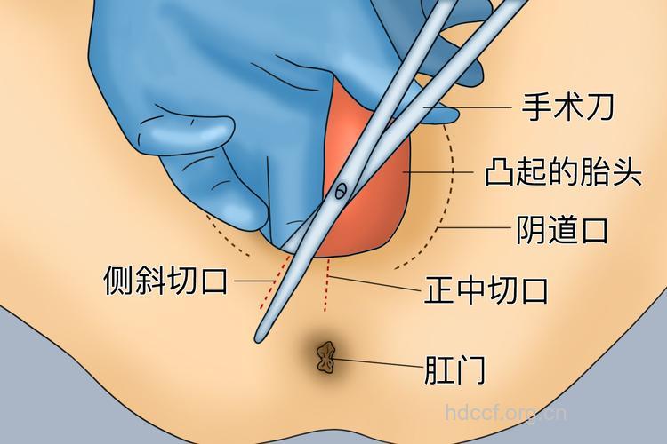 会阴侧切