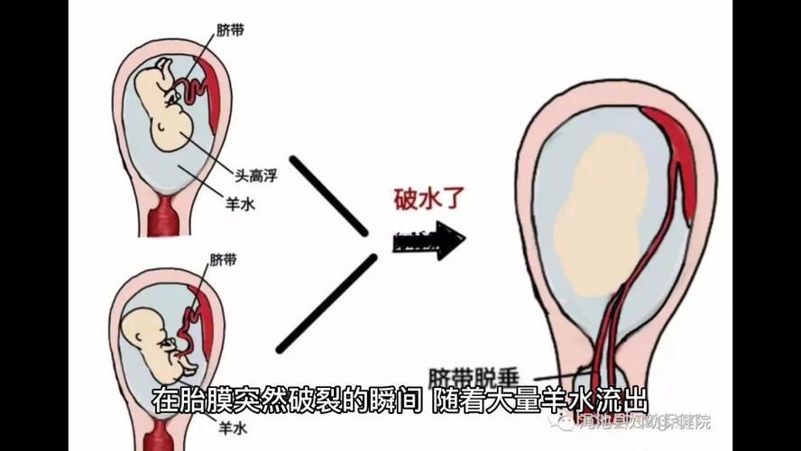 为什么会发生脐带脱垂