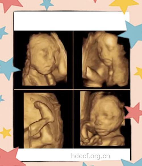 什么是四维彩超 四维彩超对胎儿有影响吗