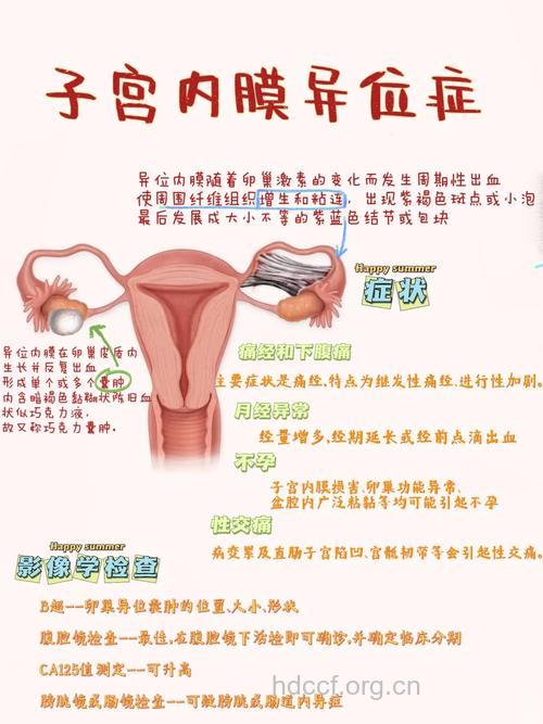 久坐易造成子宫内膜异位症