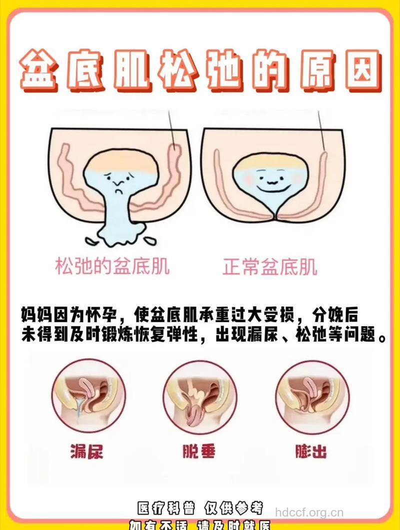 骨盆松弛