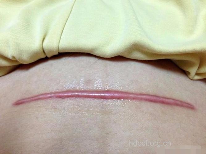 剖腹产疤痕增生