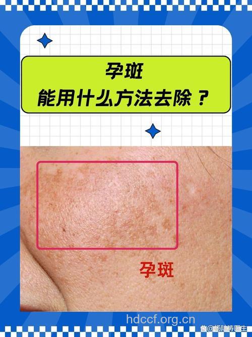 孕妇长斑不要急 这样做让你不烦恼