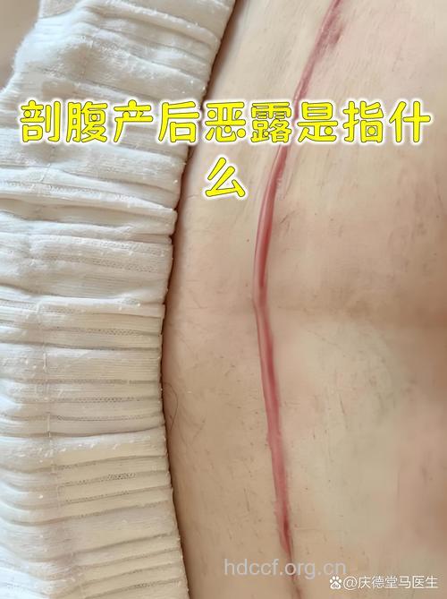 剖腹产后恶露