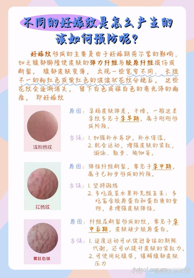 妊娠纹常见吗 这些是影响妊娠纹出现的原因