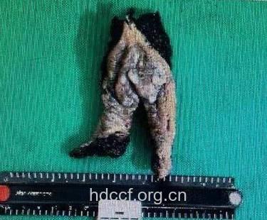 外阴鳞状上皮增生