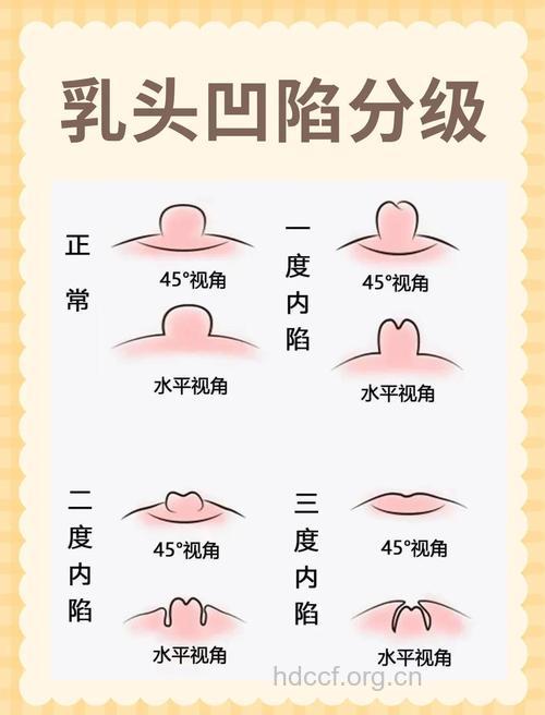 乳头内陷