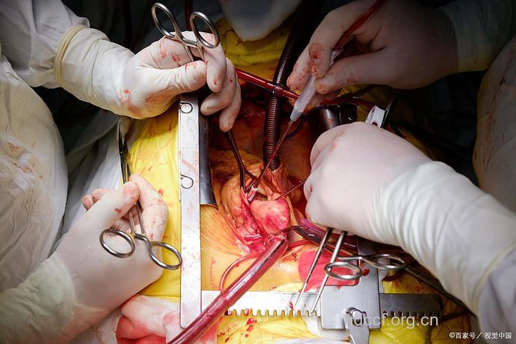 女性结扎手术