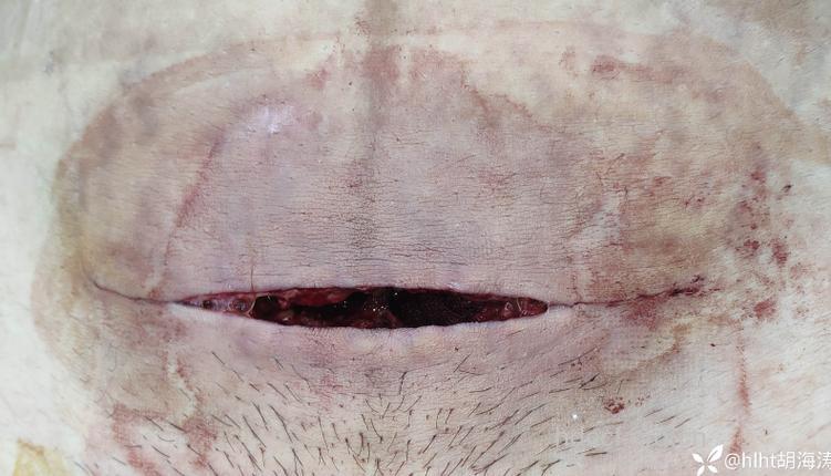 产后会阴伤口感染