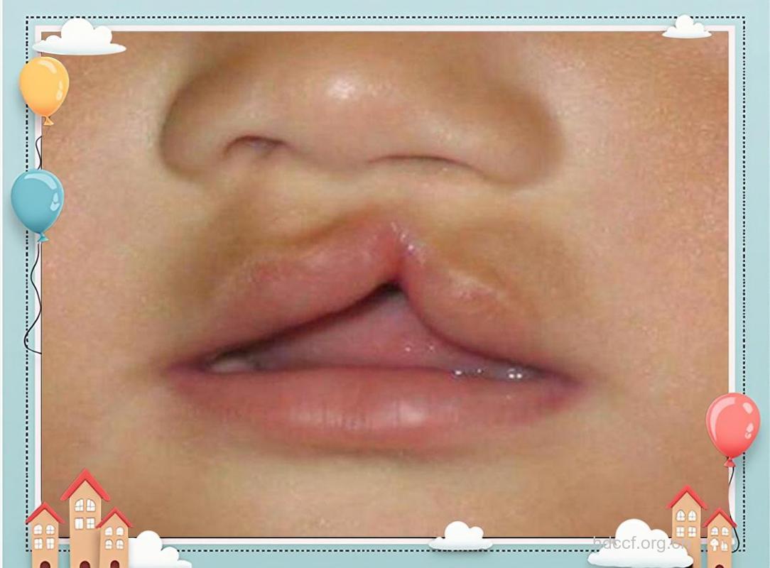 新生儿唇裂