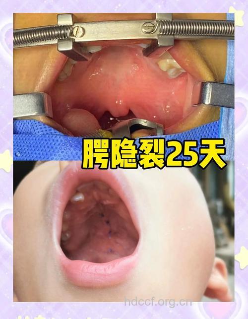 新生儿腭裂