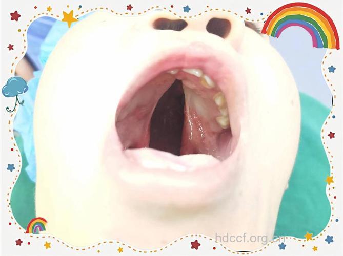 先天性唇腭裂