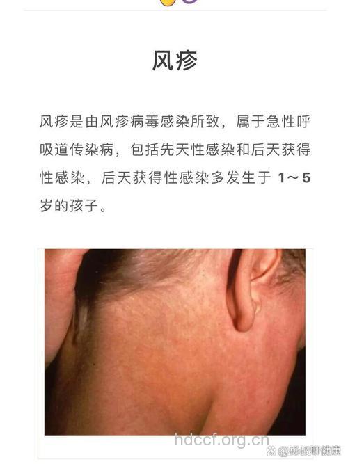 新生儿风疹