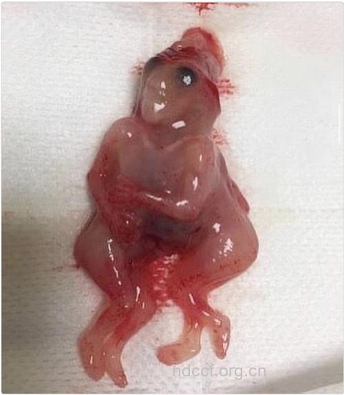 英母亲宫外孕 腹腔孕育“奇迹宝宝”