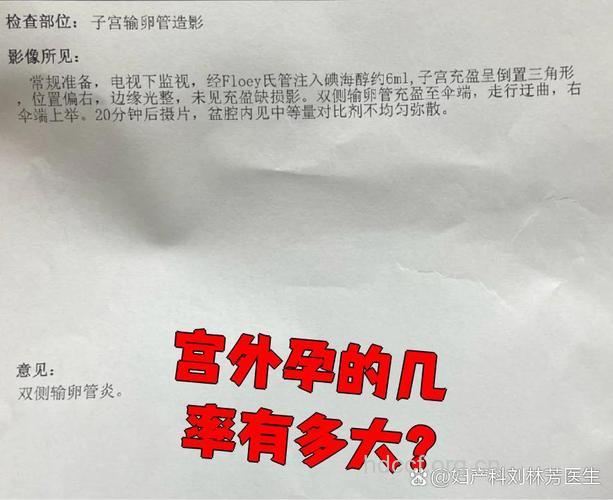 宫外孕复发的几率是多少