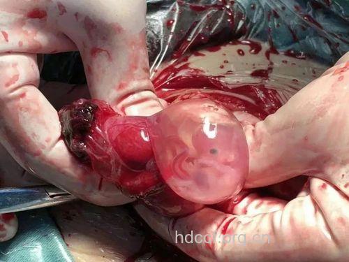 宫外孕有多可怕