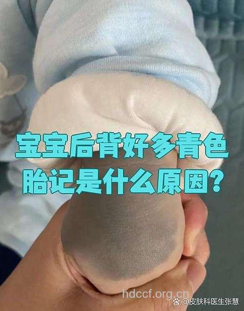 宝宝青色胎记