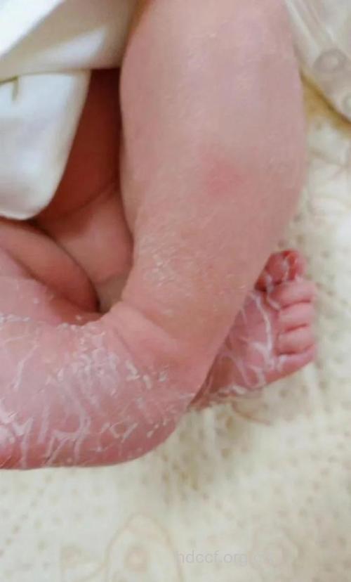 新生儿皮肤生理现象