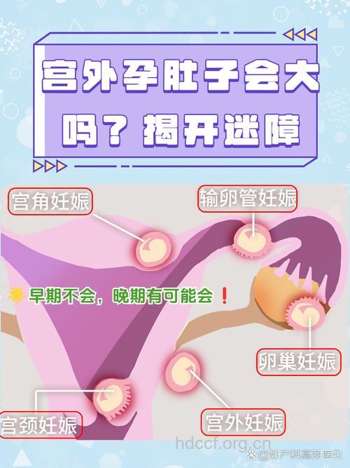 盆腔哪些异常易导致宫外孕