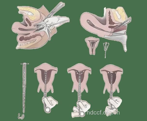 放置宫内节孕器易发生宫外孕